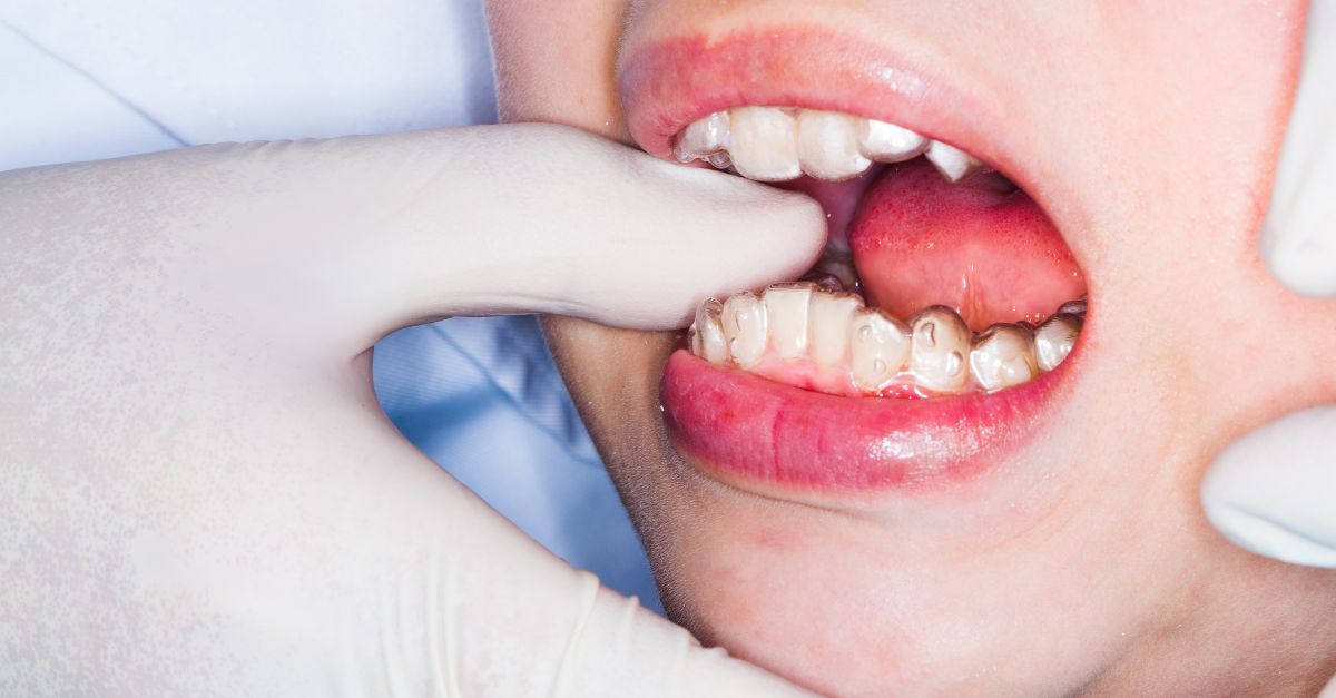 Cabinet  orthodontie AS Torcy appareil dentaire invisisbles pour ado