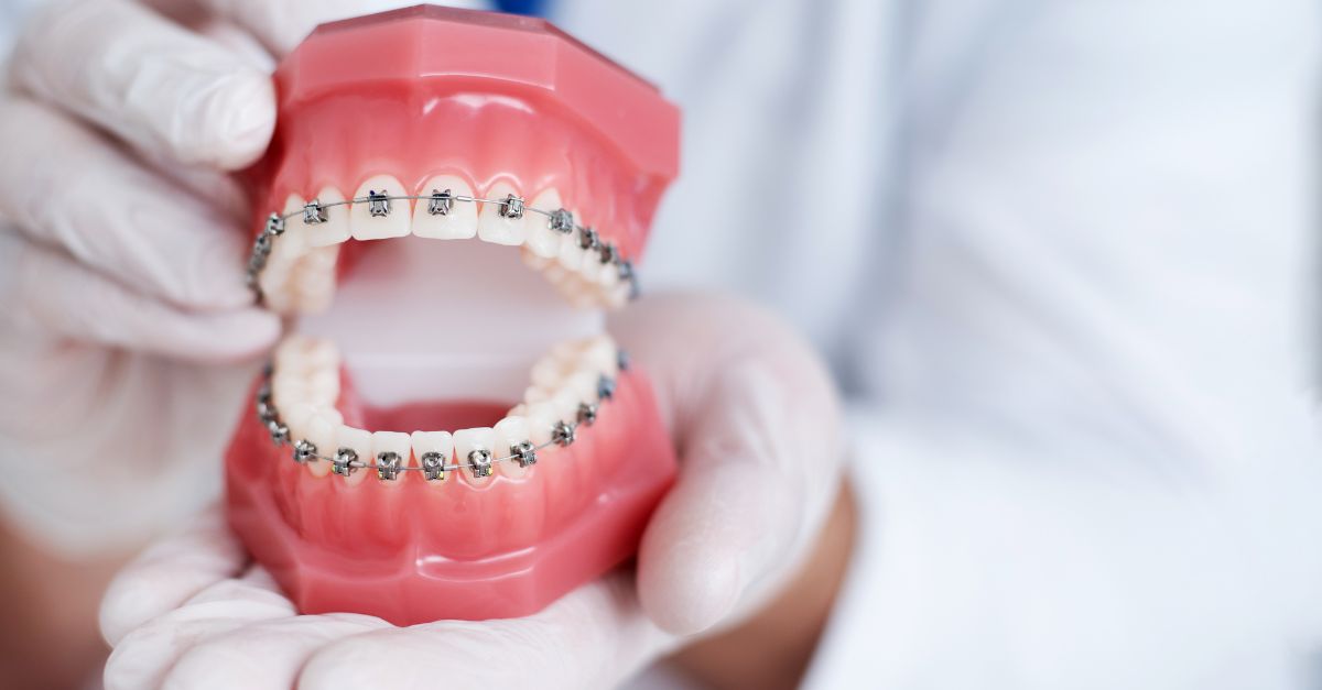 Cabinet dentaire et orthodontie AS Torcy bagues dentaires autoligaturantes